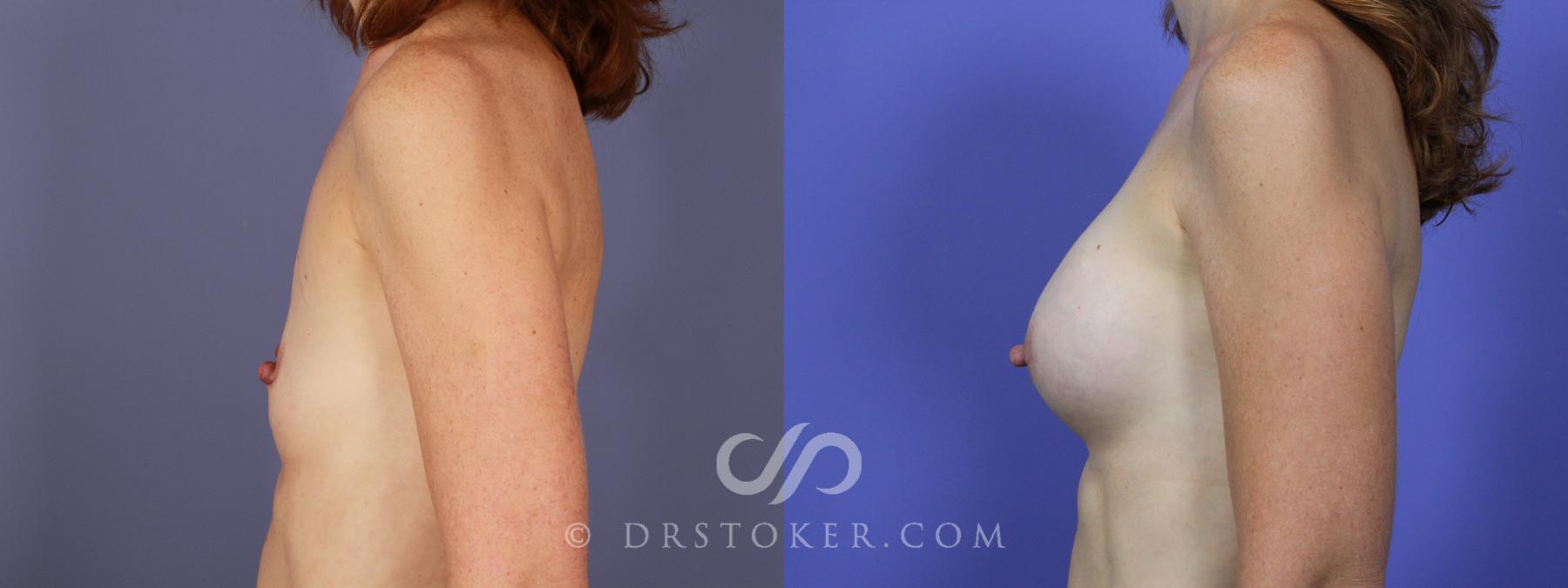 Before & After Breast Augmentation, Rapid Recovery Case 1268 View #5 View in Los Angeles, CA
