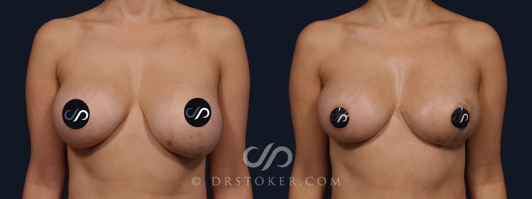 Before & After Breast Asymmetry Correction Case 2062 Front View in Los Angeles, CA