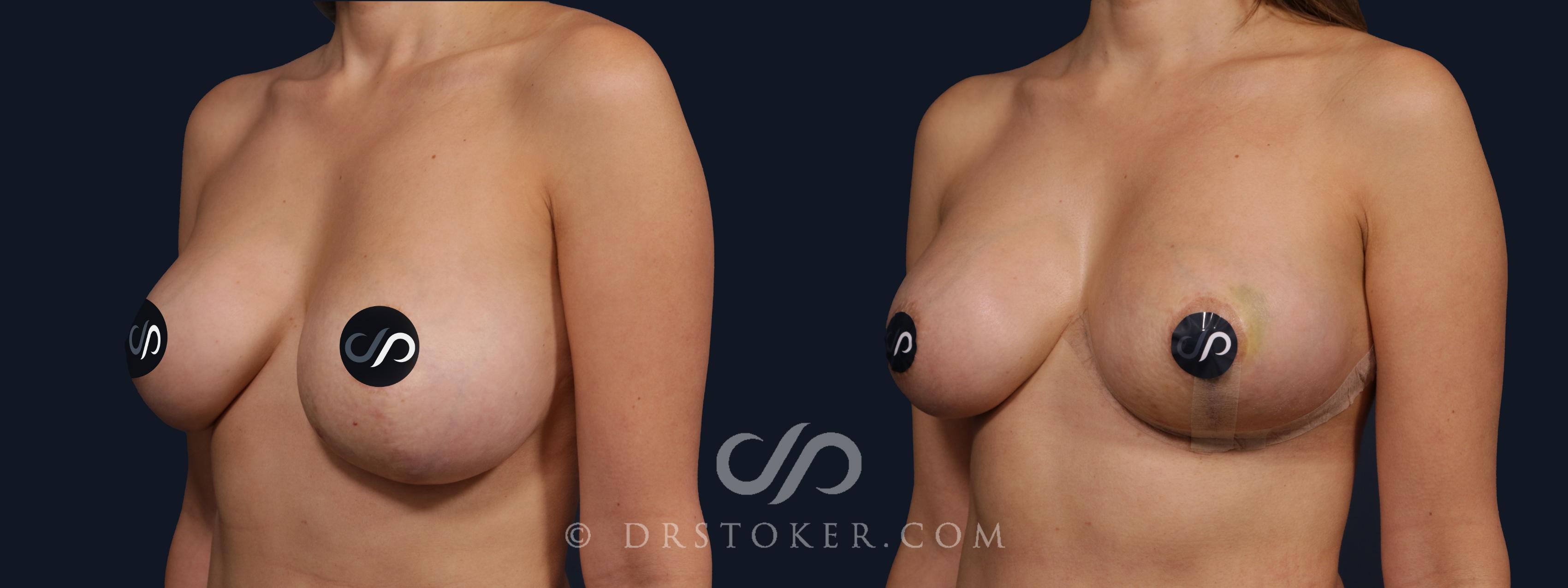 Before & After Breast Asymmetry Correction Case 2062 Left Oblique View in Los Angeles, CA