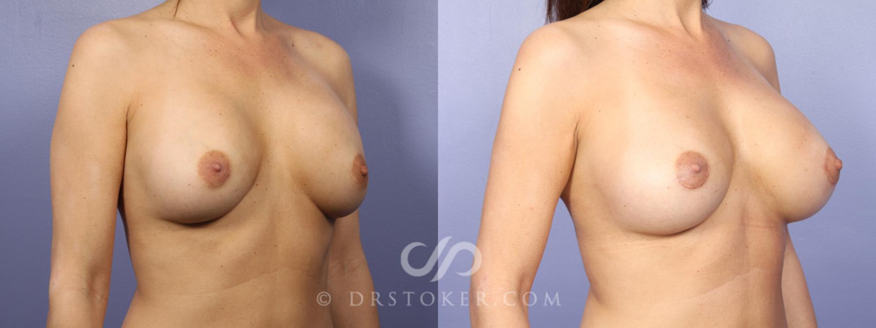 Before & After Breast Implant Correction Case 366 View #6 View in Los Angeles, CA