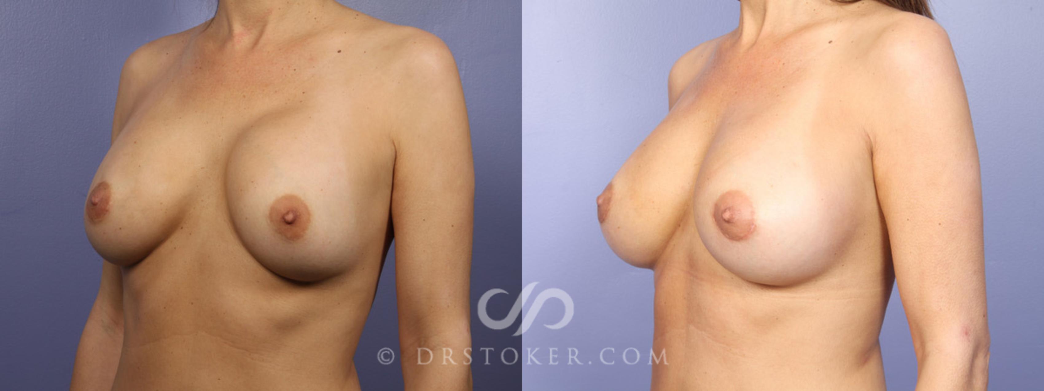 Before & After Breast Asymmetry Correction Case 366 View #7 View in Los Angeles, CA