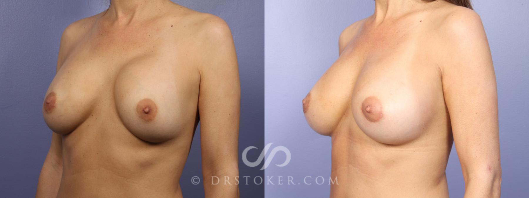 Before & After Breast Implant Correction Case 366 View #7 View in Los Angeles, CA