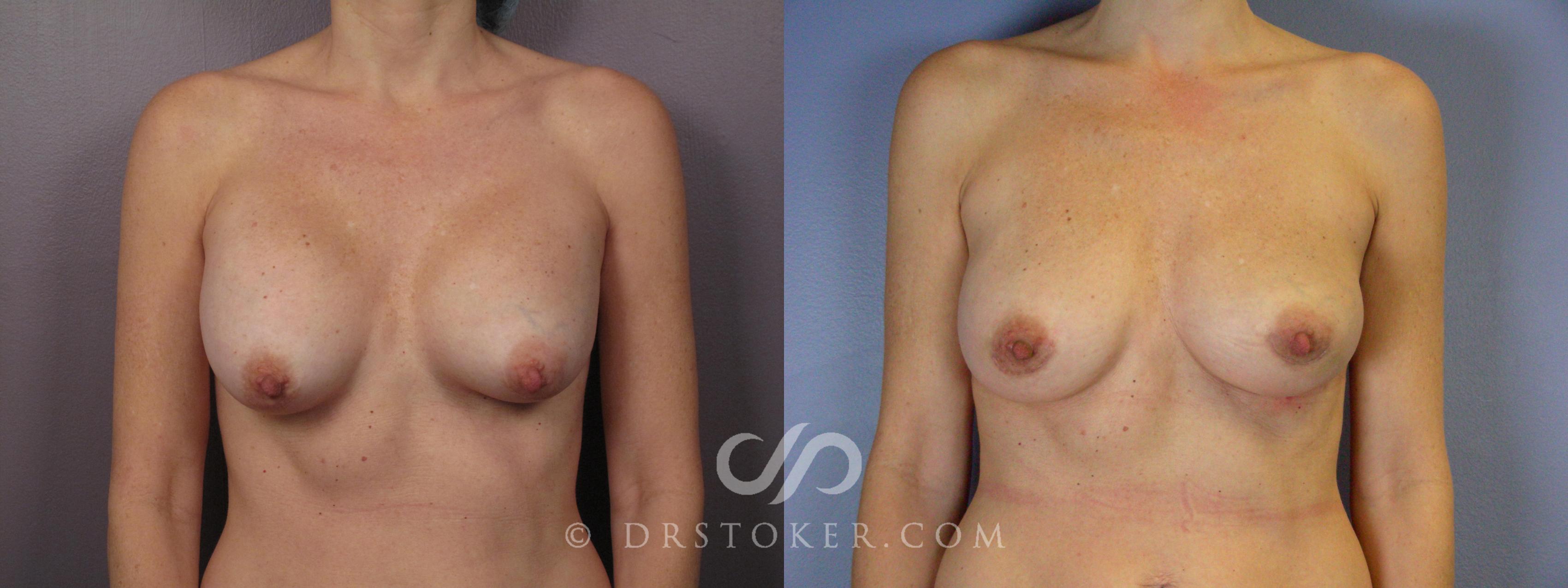 Before & After Breast Implant Correction Case 385 View #1 View in Los Angeles, CA