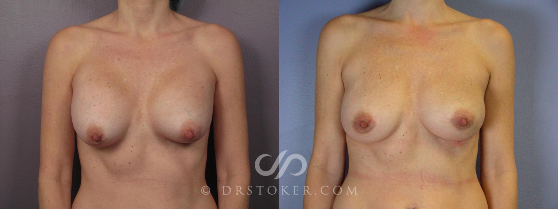 Before & After Breast Asymmetry Correction Case 385 View #1 View in Los Angeles, CA