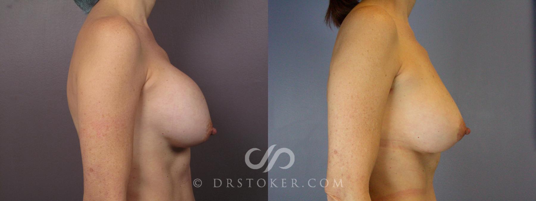 Before & After Breast Implant Correction Case 385 View #2 View in Los Angeles, CA