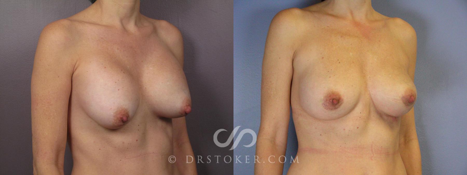 Before & After Breast Implant Correction Case 385 View #3 View in Los Angeles, CA