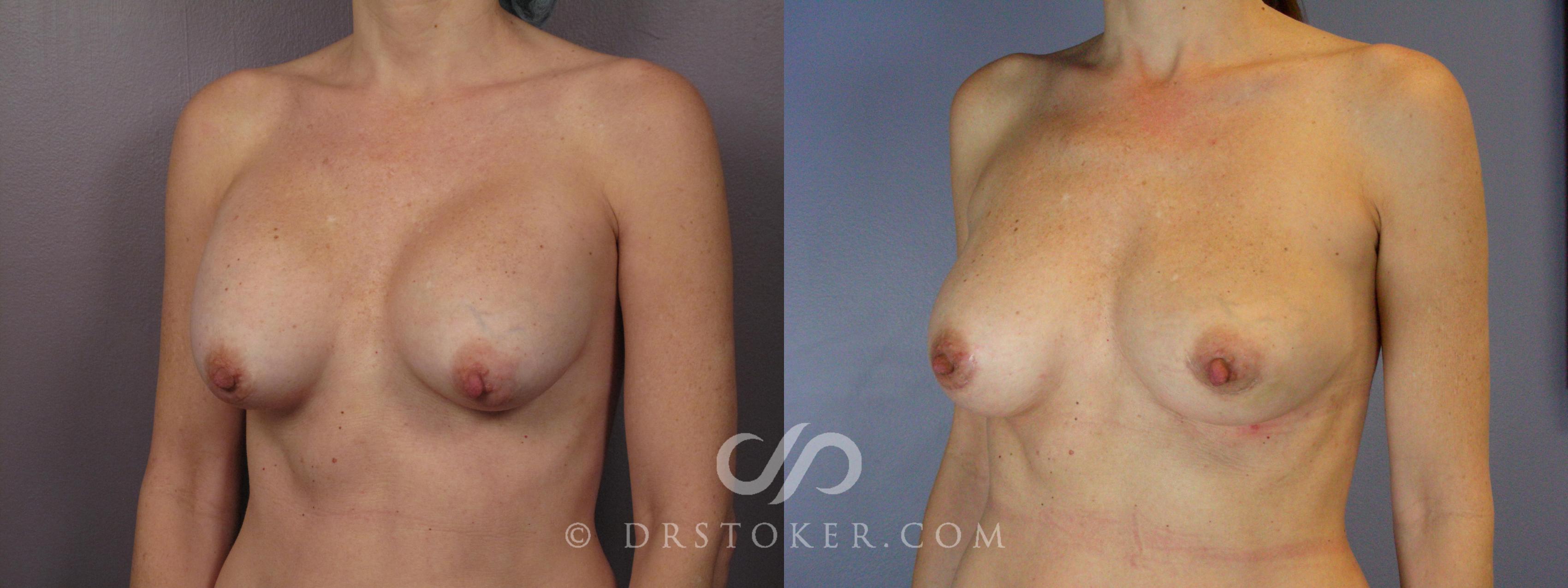 Before & After Breast Asymmetry Correction Case 385 View #4 View in Los Angeles, CA