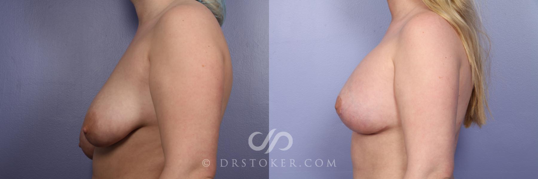 Before & After Breast Lift Case 387 View #2 View in Los Angeles, CA