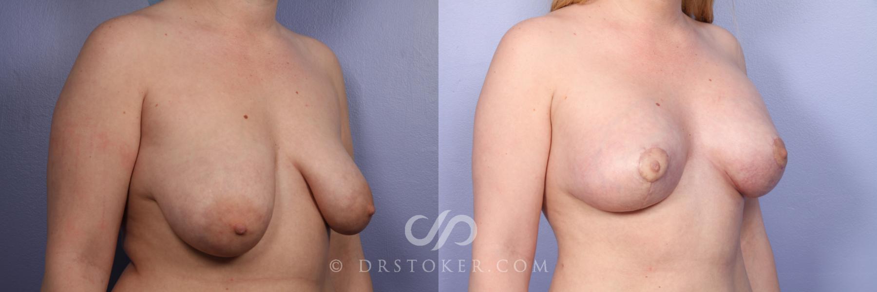 Before & After Breast Augmentation with Lift Case 387 View #4 View in Los Angeles, CA