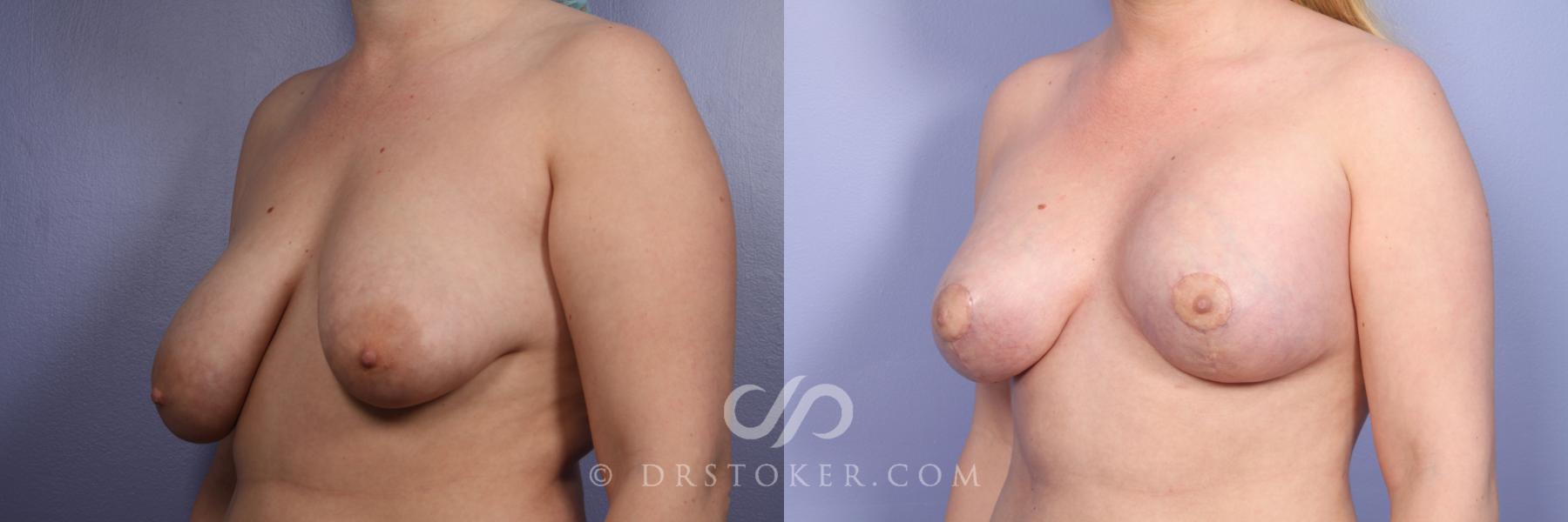 Before & After Breast Augmentation with Lift Case 387 View #5 View in Los Angeles, CA