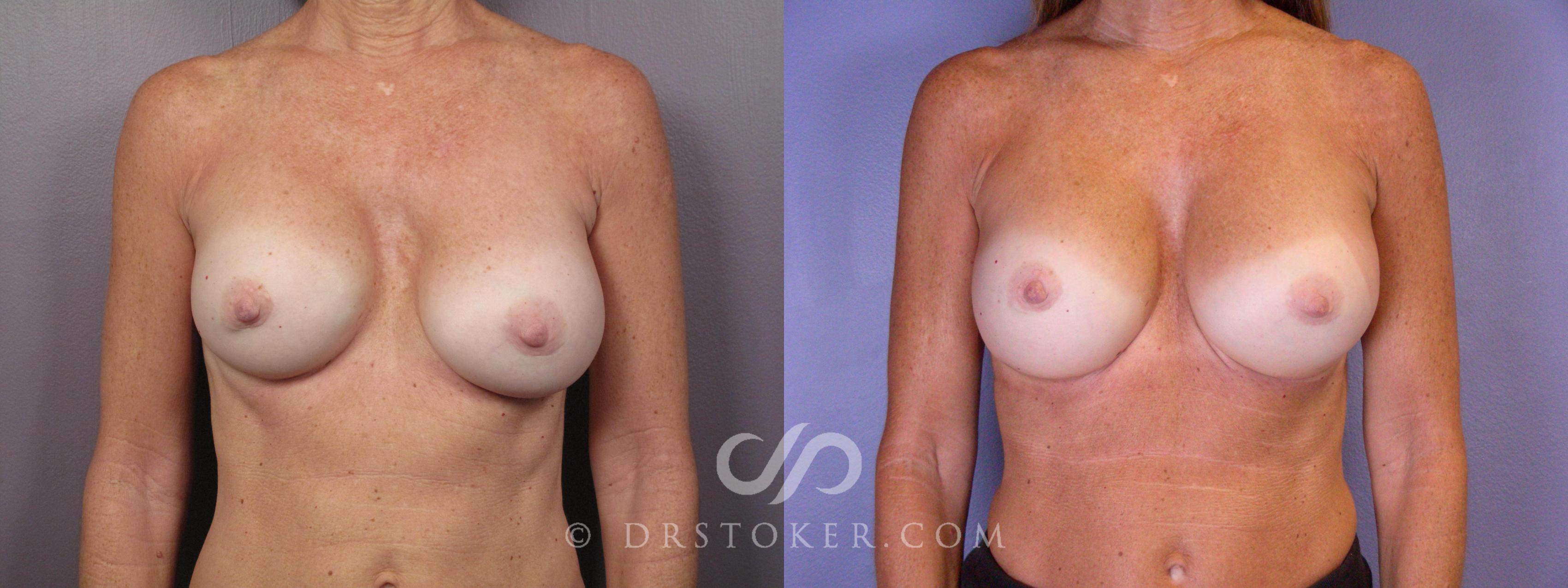 Before & After Breast Implant Correction Case 449 View #1 View in Los Angeles, CA