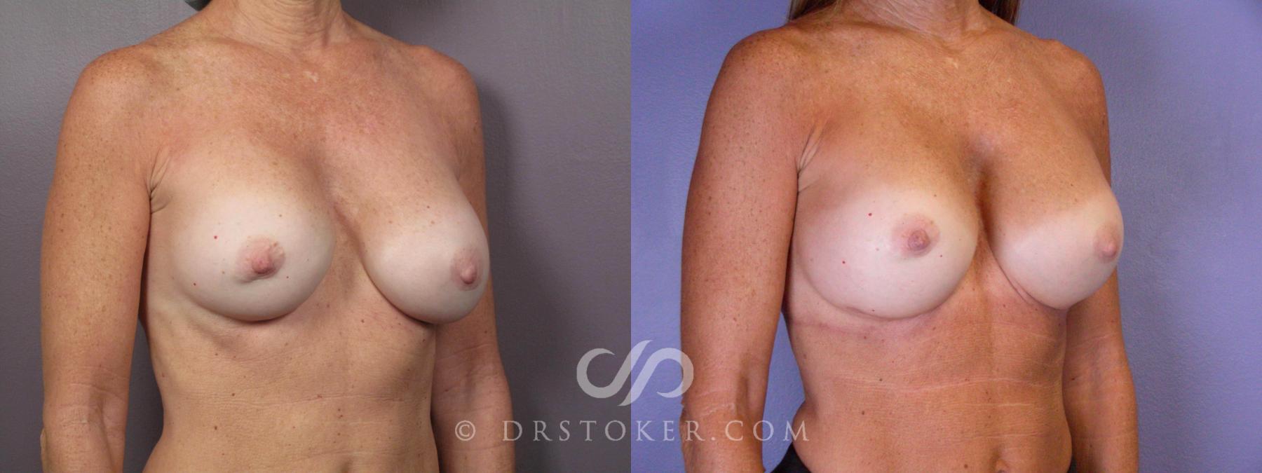 Before & After Breast Asymmetry Correction Case 449 View #2 View in Los Angeles, CA
