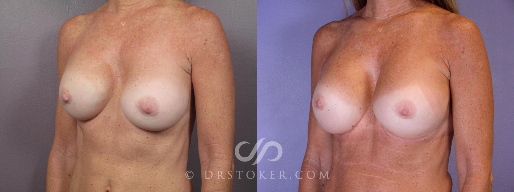 Before & After Nipple - Reduction Case 449 View #3 View in Los Angeles, CA