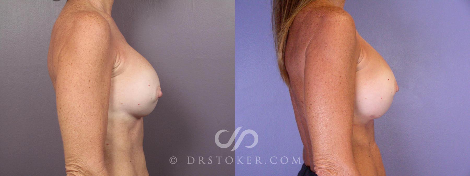 Before & After Nipple - Areola Correction Case 449 View #4 View in Los Angeles, CA