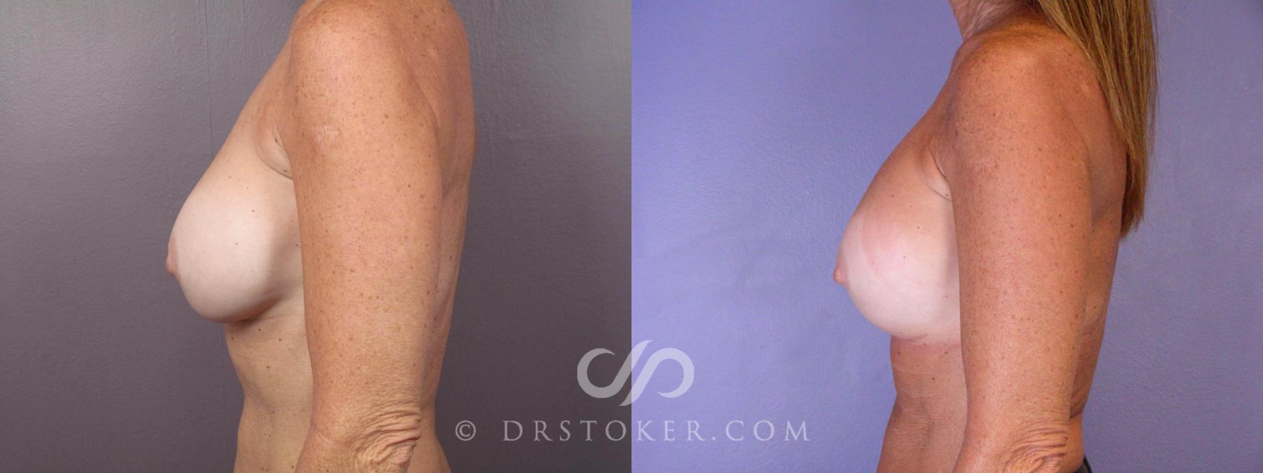 Before & After Nipple - Areola Correction Case 449 View #5 View in Los Angeles, CA