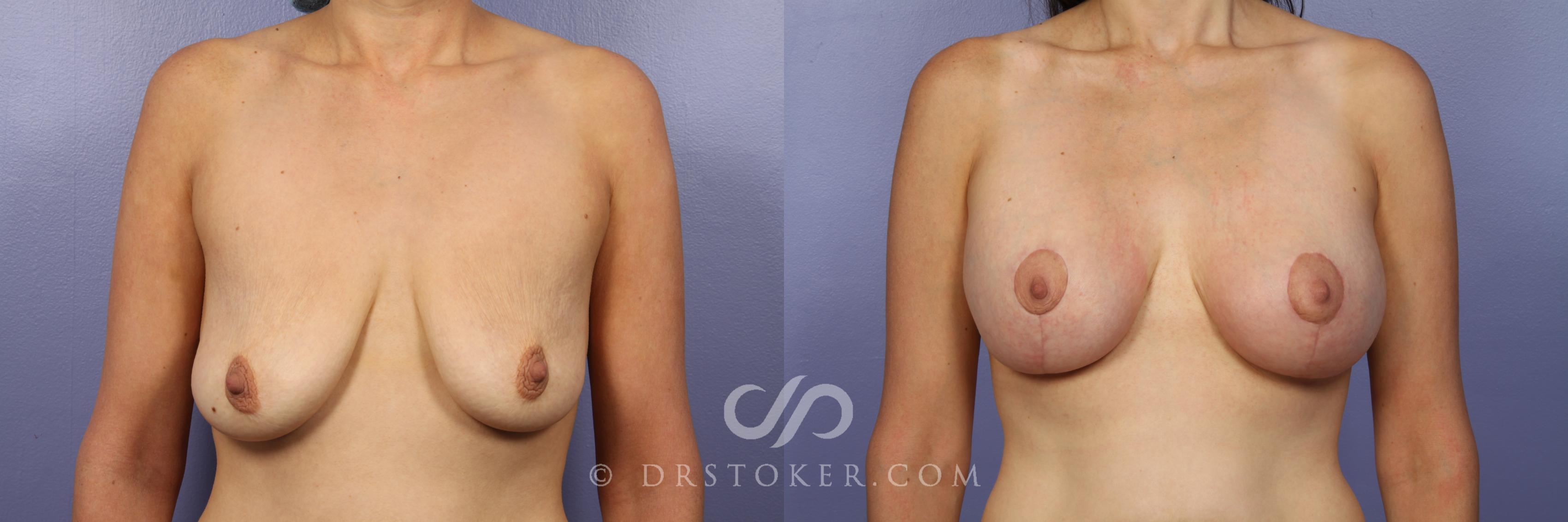 Before & After Breast Asymmetry Correction Case 454 View #1 View in Marina del Rey, CA