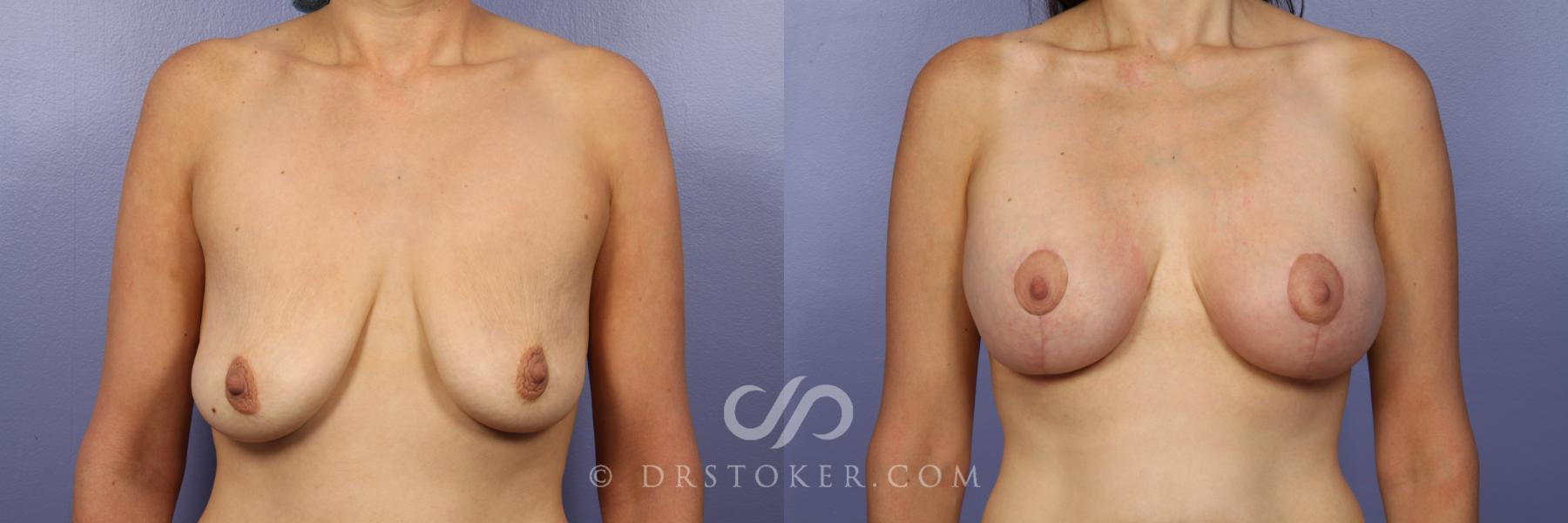 Before & After Breast Lift Case 454 View #1 View in Los Angeles, CA