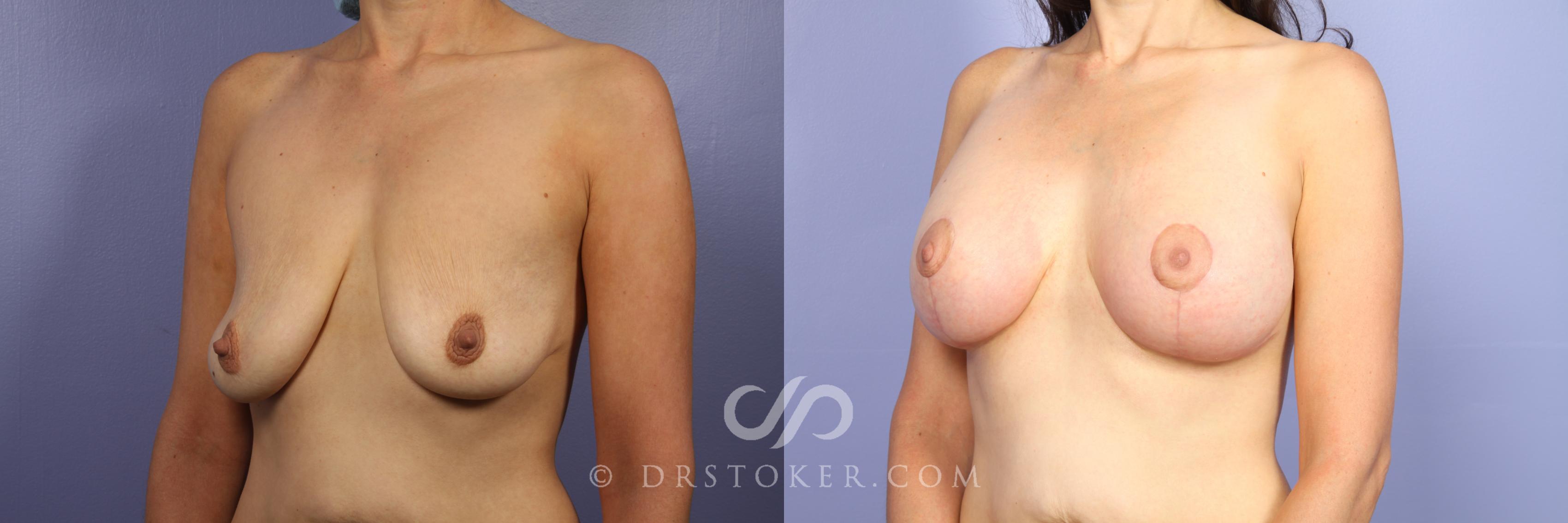 Before & After Breast Asymmetry Correction Case 454 View #3 View in Los Angeles, CA