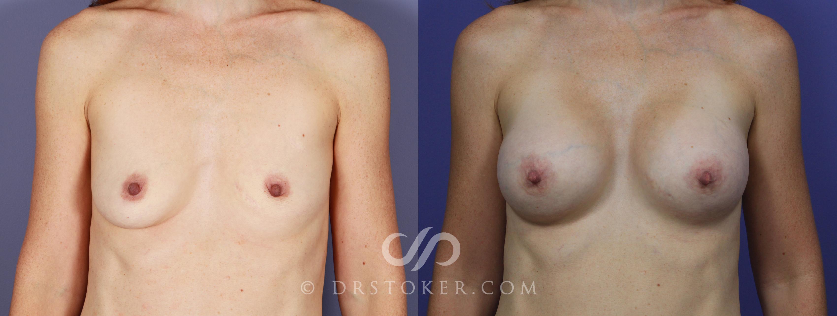 Before & After Breast Asymmetry Correction Case 968 View #1 View in Los Angeles, CA