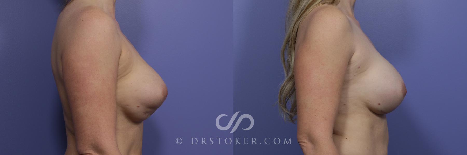 Before & After Breast Asymmetry Correction Case 969 View #3 View in Los Angeles, CA