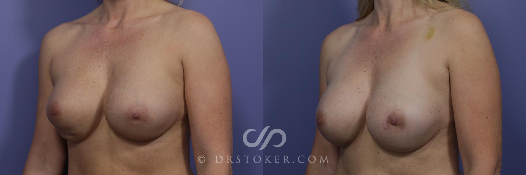 Before & After Breast Asymmetry Correction Case 969 View #4 View in Los Angeles, CA