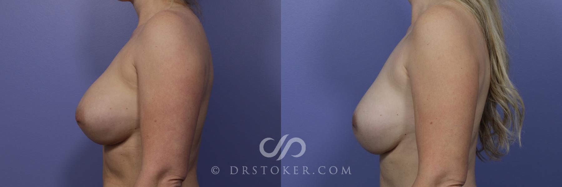 Before & After Breast Asymmetry Correction Case 969 View #5 View in Los Angeles, CA