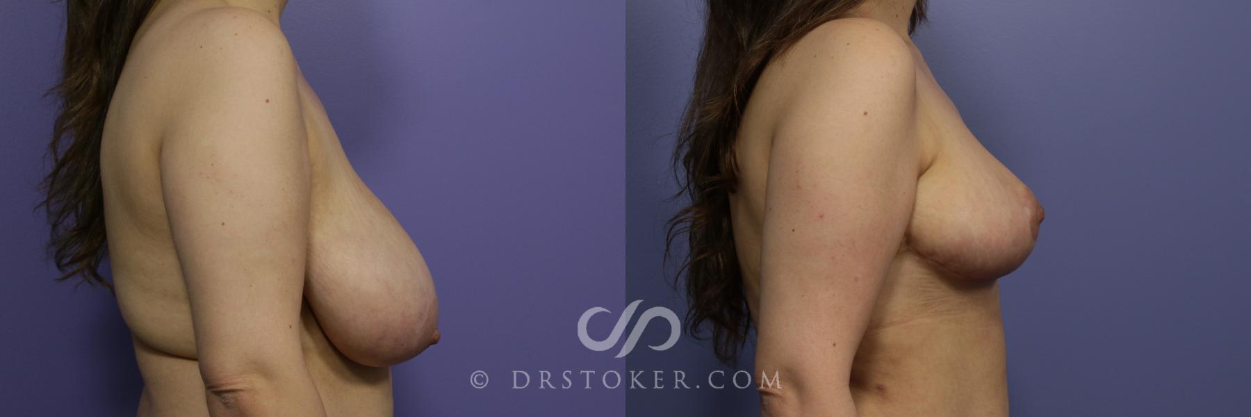 Before & After Breast Asymmetry Correction Case 970 View #3 View in Los Angeles, CA