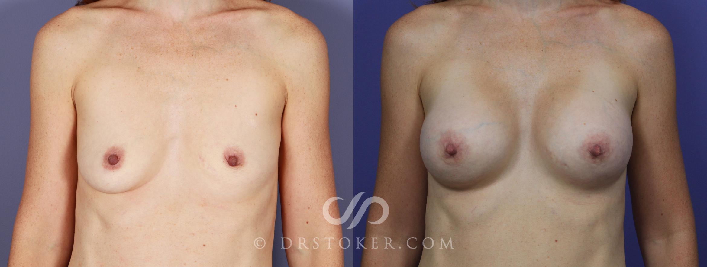 Before & After Breast Asymmetry Correction Case 1018 View #1 View in Marina del Rey, CA