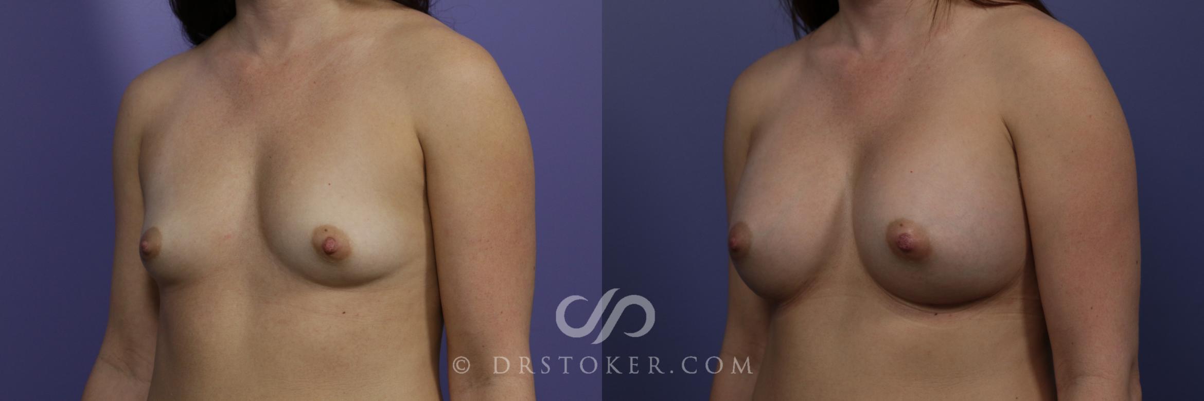 Before & After Rapid Recovery Breast Augmentation Case 1027 View #4 View in Los Angeles, CA