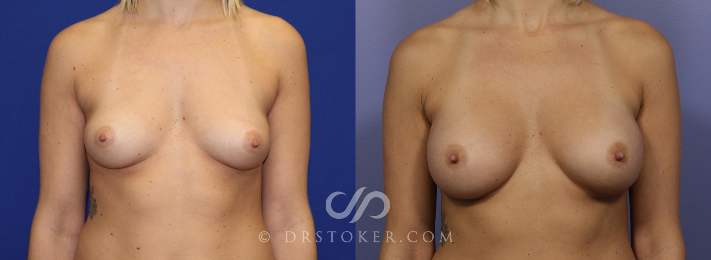 Before & After Rapid Recovery Breast Augmentation Case 1040 View #1 View in Los Angeles, CA