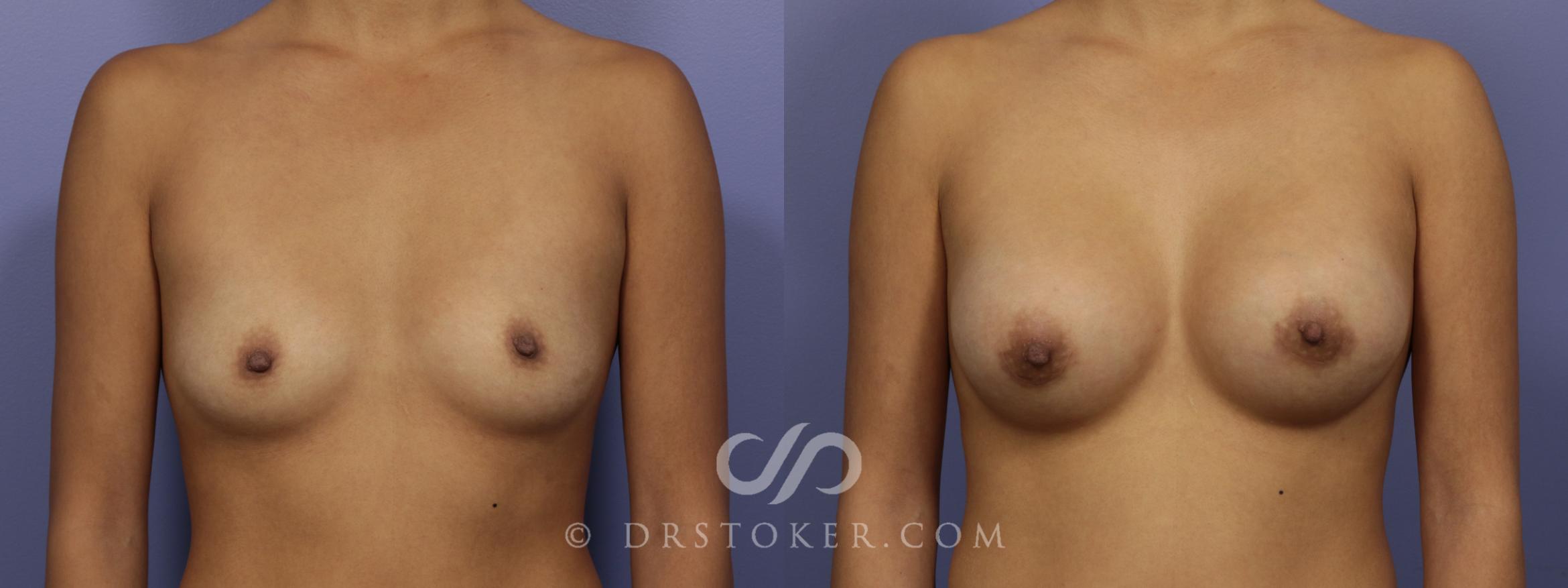 Before & After Rapid Recovery Breast Augmentation Case 1066 View #1 View in Los Angeles, CA