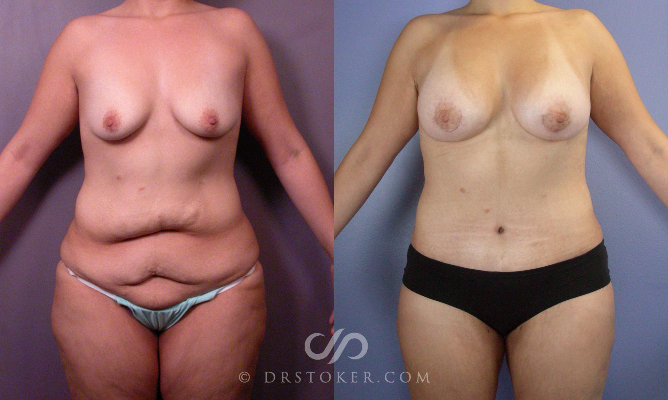 Before & After Tummy Tuck Case 107 View #1 View in Los Angeles, CA