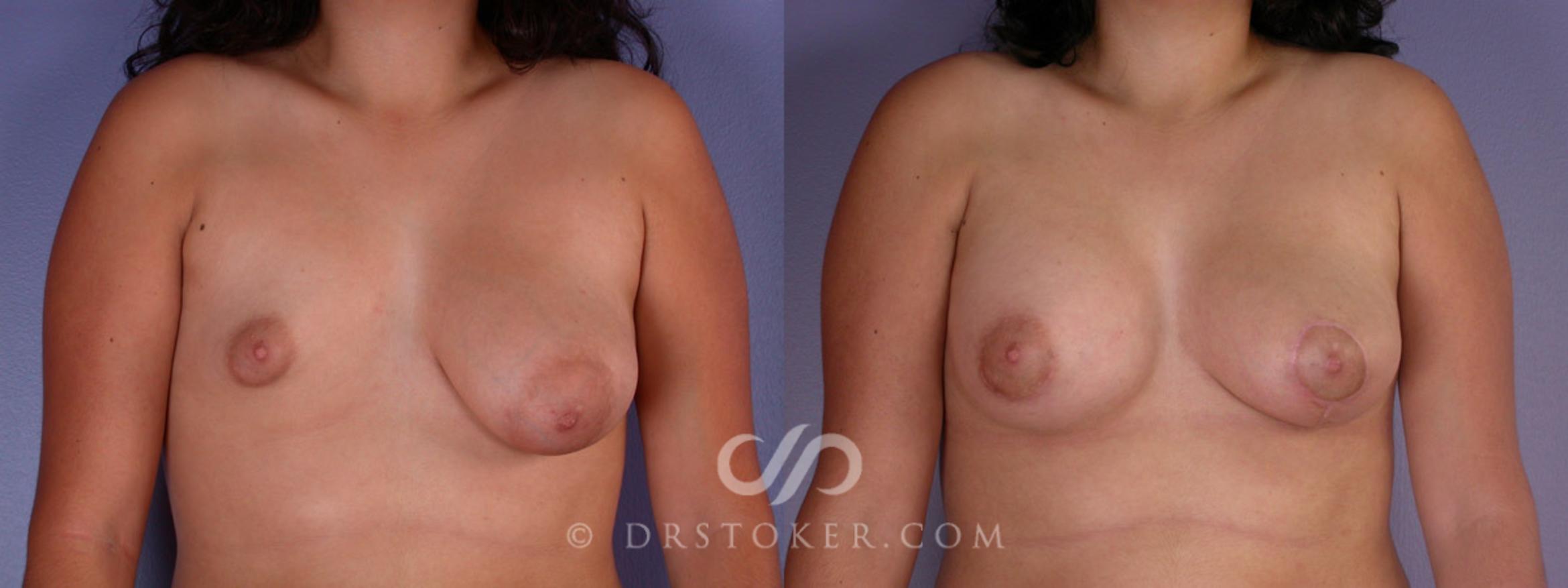 Before & After Rapid Recovery Breast Augmentation Case 191 View #1 View in Marina del Rey, CA