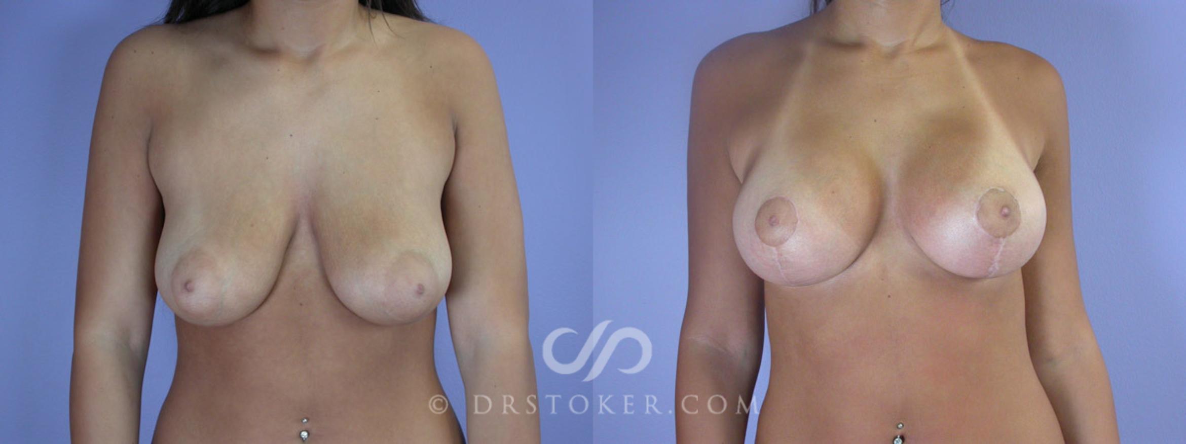 Before & After Rapid Recovery Breast Augmentation Case 192 View #1 View in Marina del Rey, CA