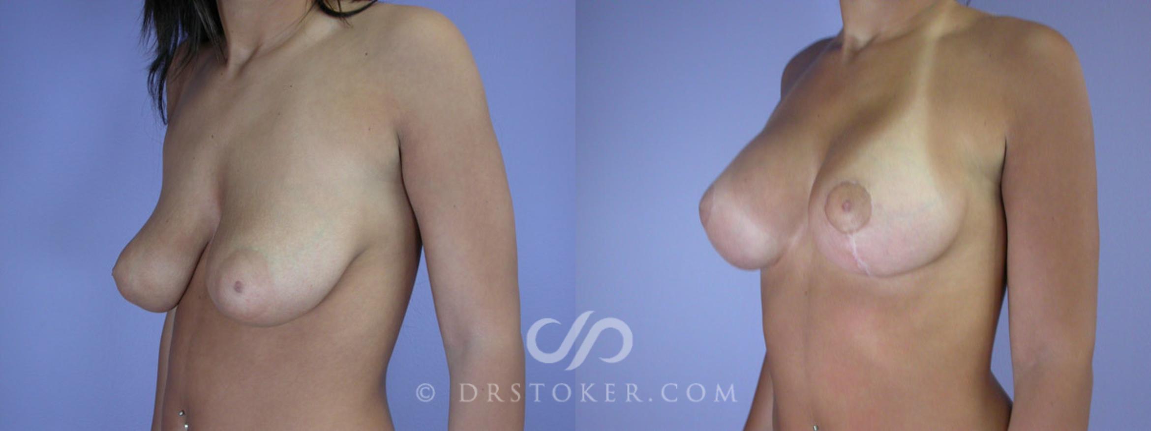 Before & After Rapid Recovery Breast Augmentation Case 192 View #3 View in Los Angeles, CA