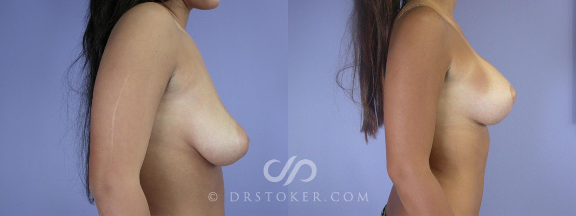 Before & After Rapid Recovery Breast Augmentation Case 192 View #5 View in Los Angeles, CA