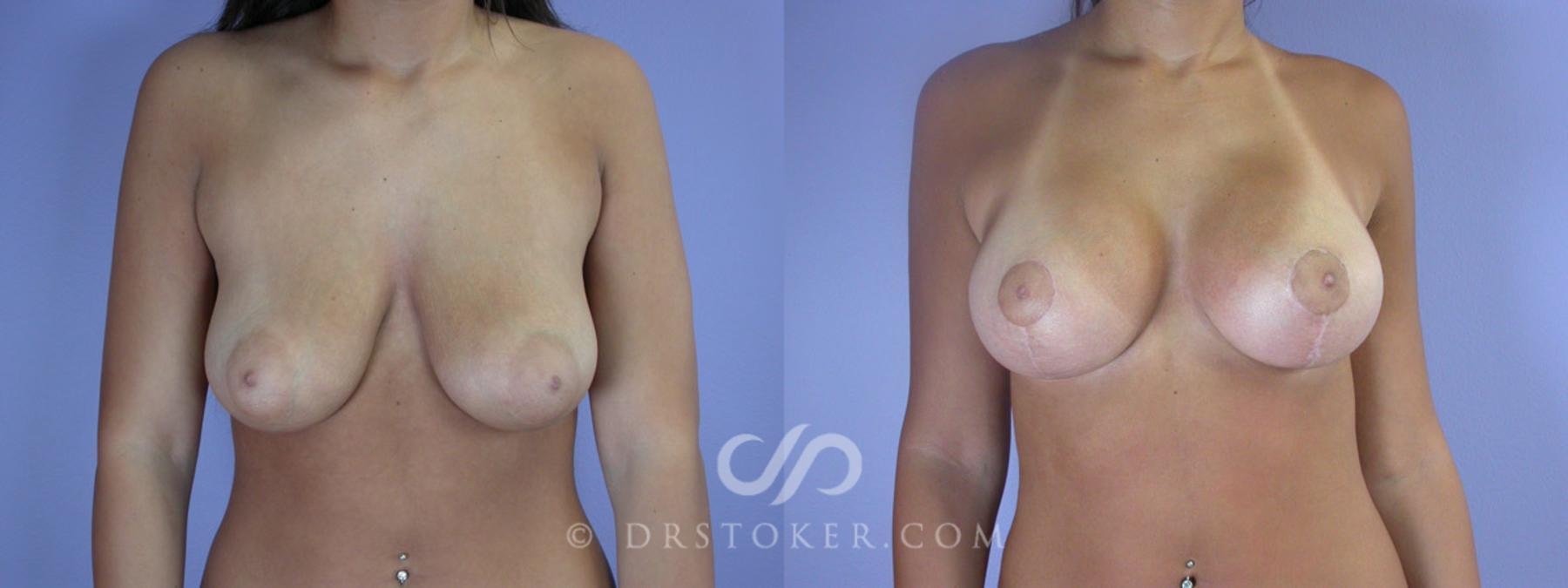 Before & After Breast Augmentation, Rapid Recovery Case 192 View #1 View in Los Angeles, CA