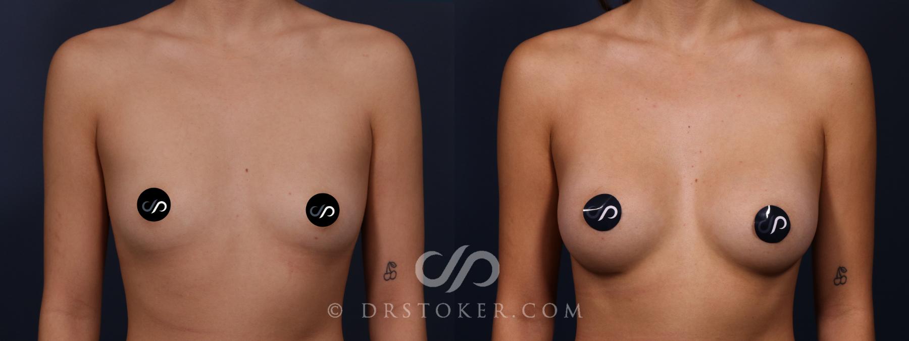 Before & After Breast Augmentation, Rapid Recovery Case 2337 Front View in Los Angeles, CA