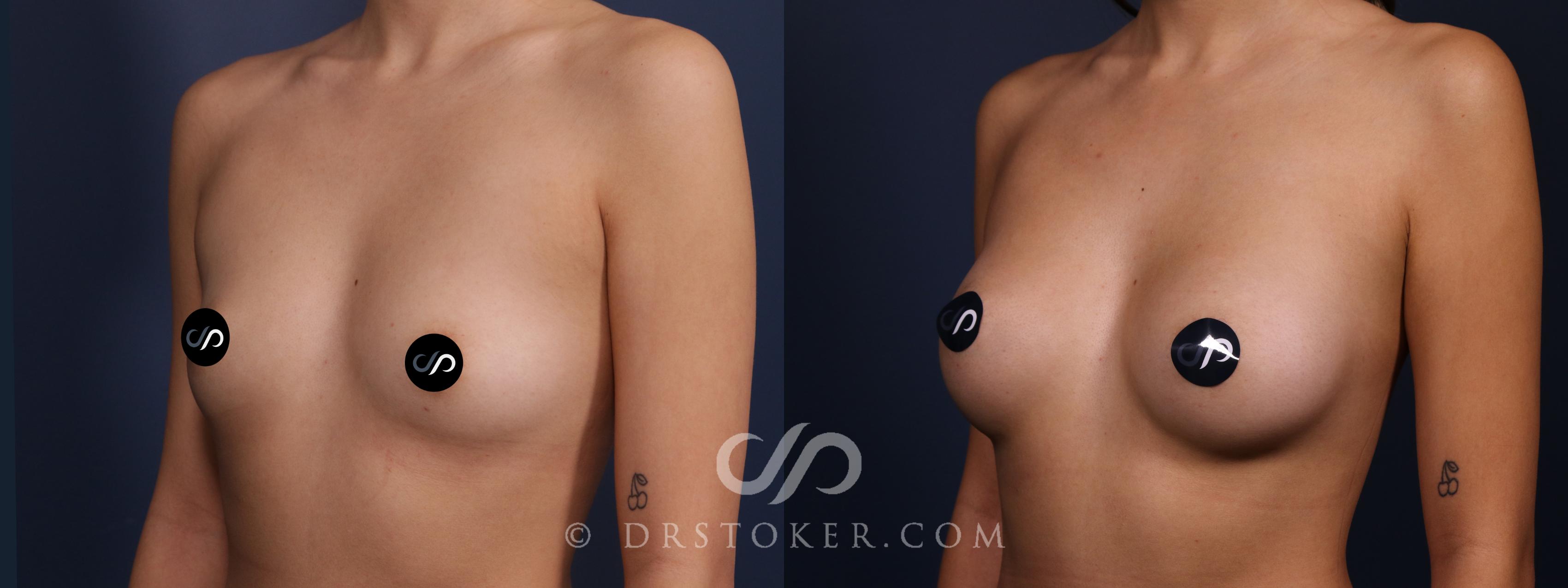 Before & After Breast Augmentation, Rapid Recovery Case 2337 Left Oblique View in Los Angeles, CA