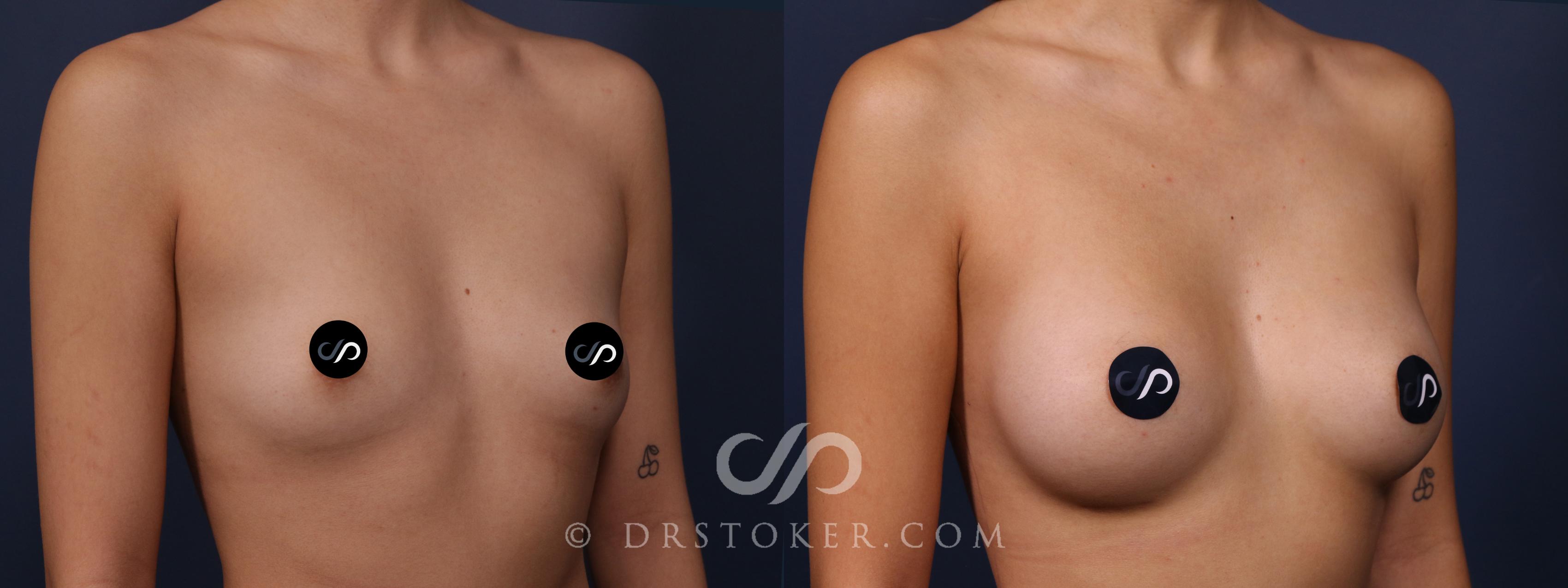 Before & After Breast Augmentation, Rapid Recovery Case 2337 Right Oblique View in Los Angeles, CA