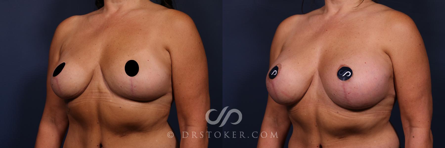 Before & After Breast Augmentation, Rapid Recovery Case 2570 Left Oblique View in Los Angeles, CA