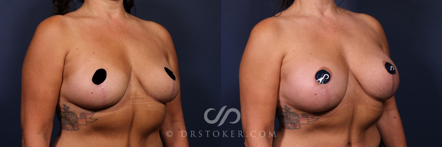 Before & After Breast Augmentation, Rapid Recovery Case 2570 Right Oblique View in Los Angeles, CA