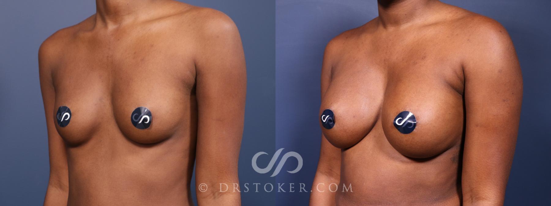 Before & After Breast Augmentation, Rapid Recovery Case 2574 Left Oblique View in Los Angeles, CA