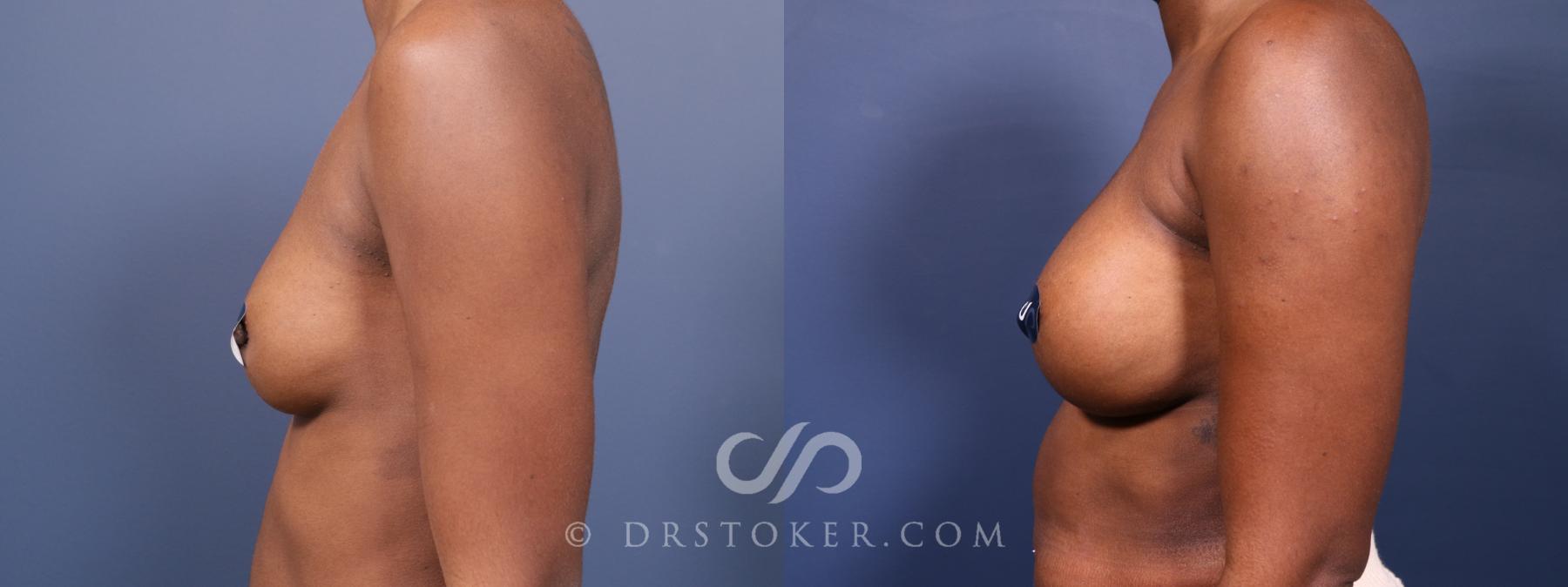 Before & After Breast Augmentation, Rapid Recovery Case 2574 Left Side View in Los Angeles, CA