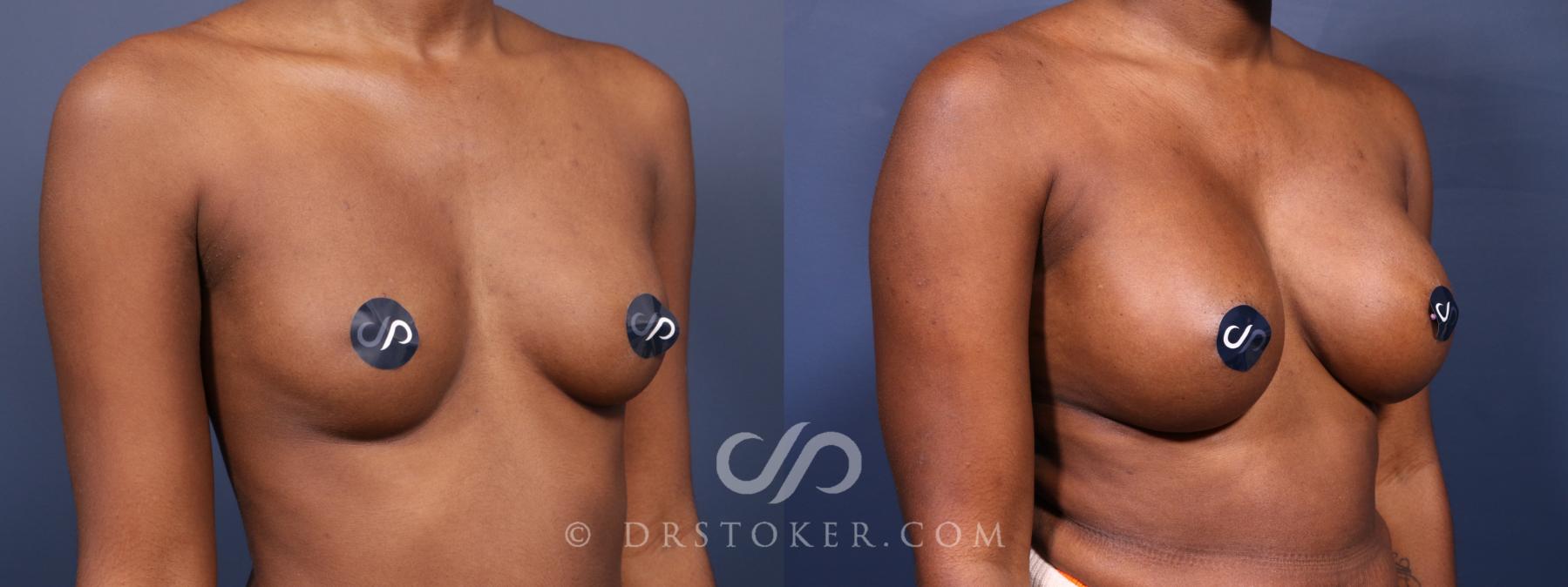 Before & After Breast Augmentation, Rapid Recovery Case 2574 Right Oblique View in Los Angeles, CA