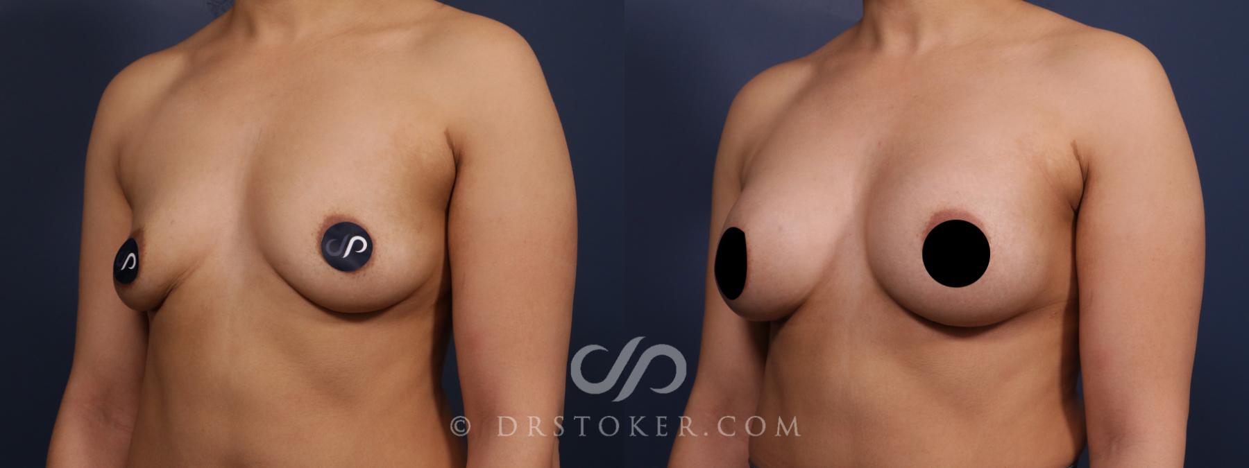 Before & After Breast Augmentation, Rapid Recovery Case 2580 Left Oblique View in Los Angeles, CA