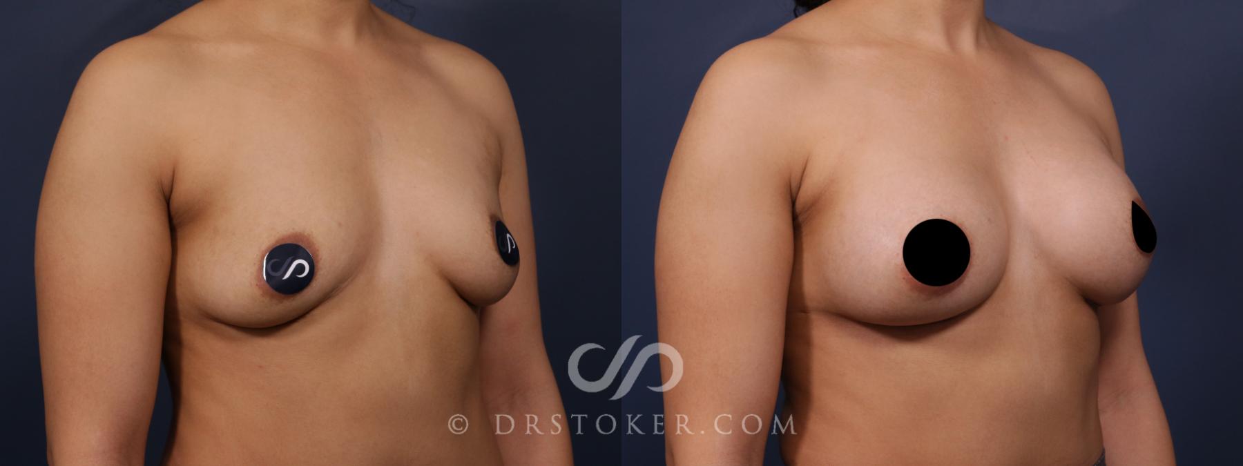 Before & After Breast Augmentation, Rapid Recovery Case 2580 Right Oblique View in Los Angeles, CA