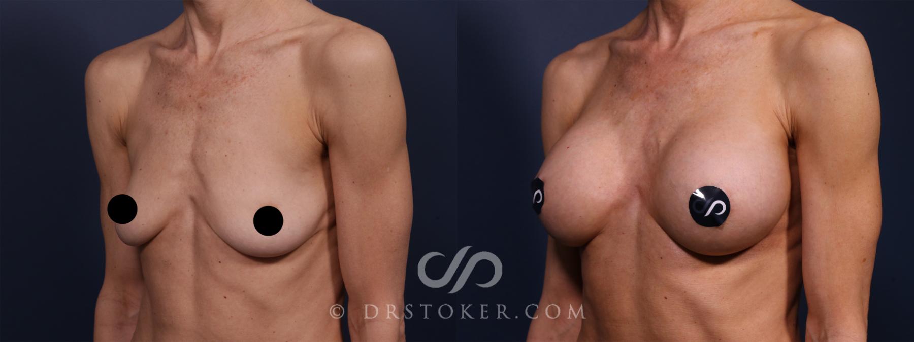Before & After Breast Augmentation, Rapid Recovery Case 2593 Left Oblique View in Los Angeles, CA