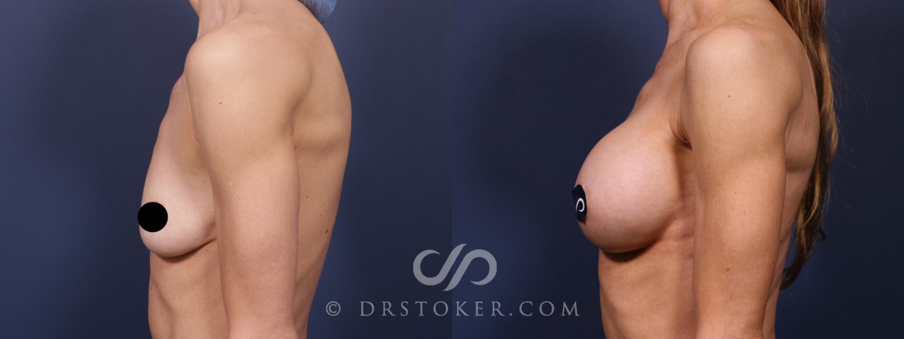 Before & After Breast Augmentation, Rapid Recovery Case 2593 Left Side View in Los Angeles, CA