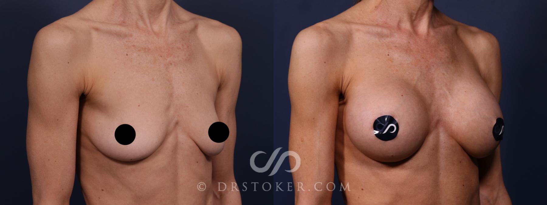 Before & After Breast Augmentation, Rapid Recovery Case 2593 Right Oblique View in Los Angeles, CA
